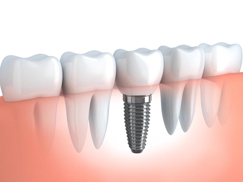 Dental Implants Boston, MA 